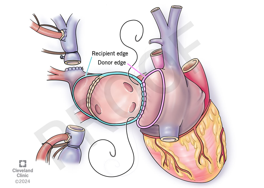 Anthony Zaki, MD (@anthonyzakimd) on Twitter photo Novel, elegant technique for #HeartTransplant in a recipient with anomalous pulmonary veins using all native tissue <a href="/Dr_HaniNajm/">DR. Hani Najm</a> <a href="/CleClinicHVTI/">Cleveland Clinic Heart, Vascular & Thoracic</a> doi.org/10.1016/j.heal… Novel, elegant technique for #HeartTransplant in a recipient with anomalous pulmonary veins using all native tissue <a href="/Dr_HaniNajm/">DR. Hani Najm</a> <a href="/CleClinicHVTI/">Cleveland Clinic Heart, Vascular & Thoracic</a> doi.org/10.1016/j.heal…