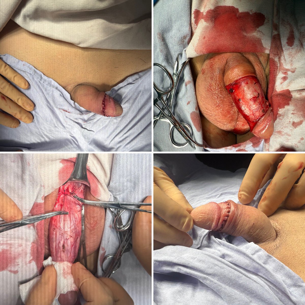 urologozmg's tweet photo. Liberación de ligamento suspensorio del pene. El paciente ganó casi 3cm de longitud https://t.co/kAkGCwEKKl