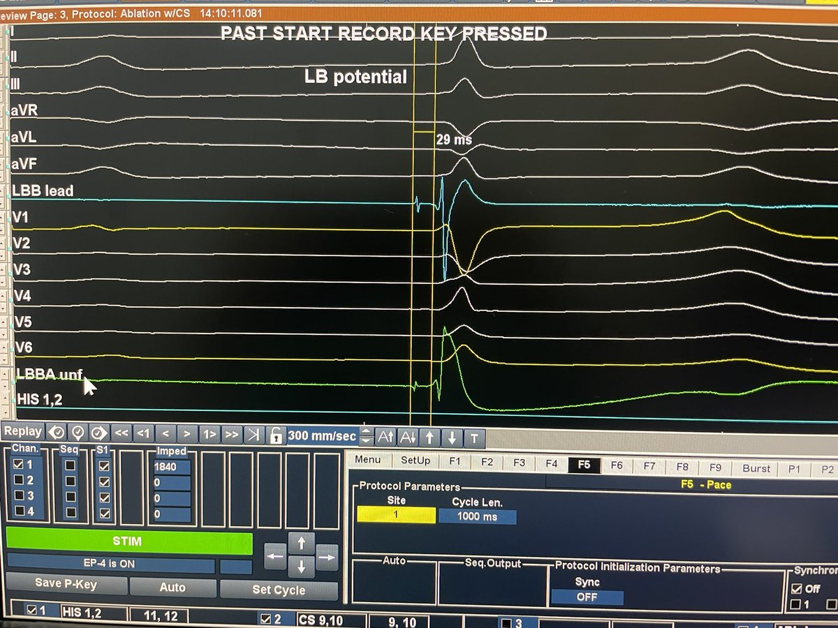 Yerlan Turubayev (@erlanturubaev) on Twitter photo 15 y.o. girl. AV block. IVS 7 mm. More perpendicular position led to septal perforation or posterior fascicle capture.
LVAT 69 ms, pot-QRS 29 ms, transiition at 0,6V. However V6-V1 less than 35.
Opinions? <a href="/curilakarol/">curilakarol</a> <a href="/OCanoPerez/">Óscar Cano</a> <a href="/shunmug_his_mdu/">Shunmuga Sundaram Ponnusamy</a> <a href="/ugurcanpolatmd/">Ugur Canpolat</a> <a href="/enes_elvin/">Enes Elvin Gul, MD, FESC, FEHRA</a> 15 y.o. girl. AV block. IVS 7 mm. More perpendicular position led to septal perforation or posterior fascicle capture.
LVAT 69 ms, pot-QRS 29 ms, transiition at 0,6V. However V6-V1 less than 35.
Opinions? <a href="/curilakarol/">curilakarol</a> <a href="/OCanoPerez/">Óscar Cano</a> <a href="/shunmug_his_mdu/">Shunmuga Sundaram Ponnusamy</a> <a href="/ugurcanpolatmd/">Ugur Canpolat</a> <a href="/enes_elvin/">Enes Elvin Gul, MD, FESC, FEHRA</a>