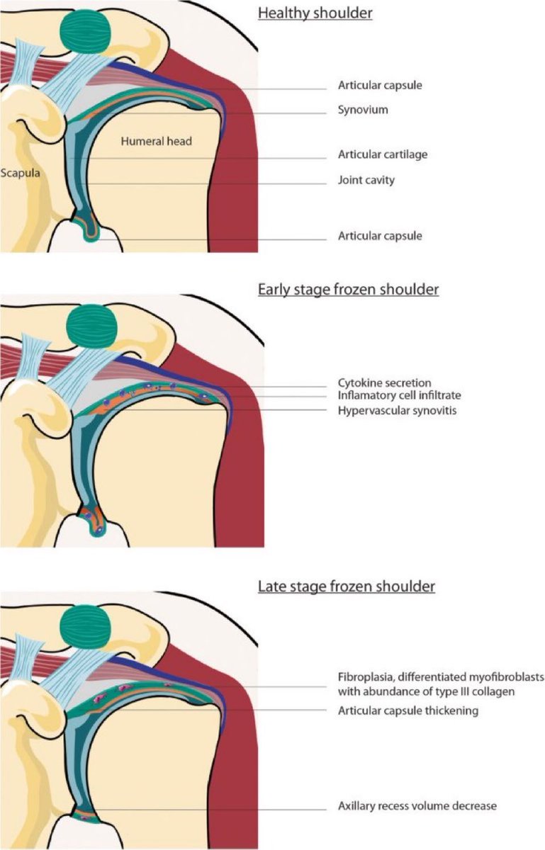 Stages of Frozen Shoulder (FS)

Healthy shoulder (top)

Early stage FS👉inflammation, synovial hyperplasia, hypervascularity, neurogenesis

Late stage FS👉increased fibroblasts, fibrosis, dense extra cellular matrix, capsular thickening

#shoulder 

jeo-esska.springeropen.com/articles/10.11…