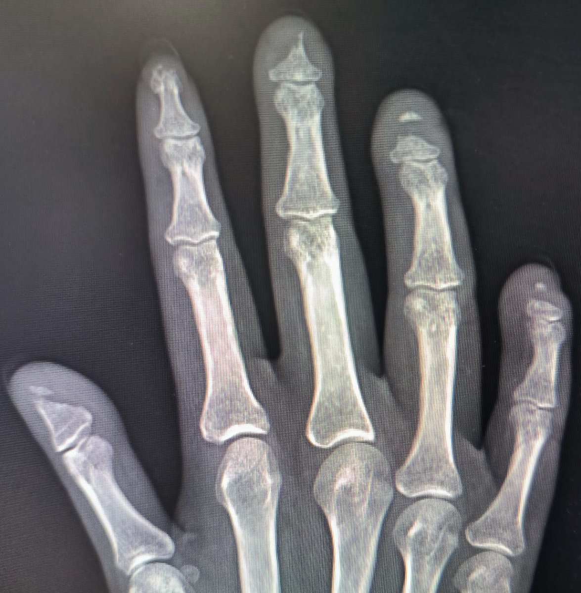ConsejosReumato's tweet photo. Los pacientes con #esclerodermia pueden presentar #acroosteolisis ( RX manos ) , esto es una resorción ósea de las falanges distales debido a isquemia prolongada. #PSS #scleroderma #fingers #hand https://t.co/P6BMbT14uA