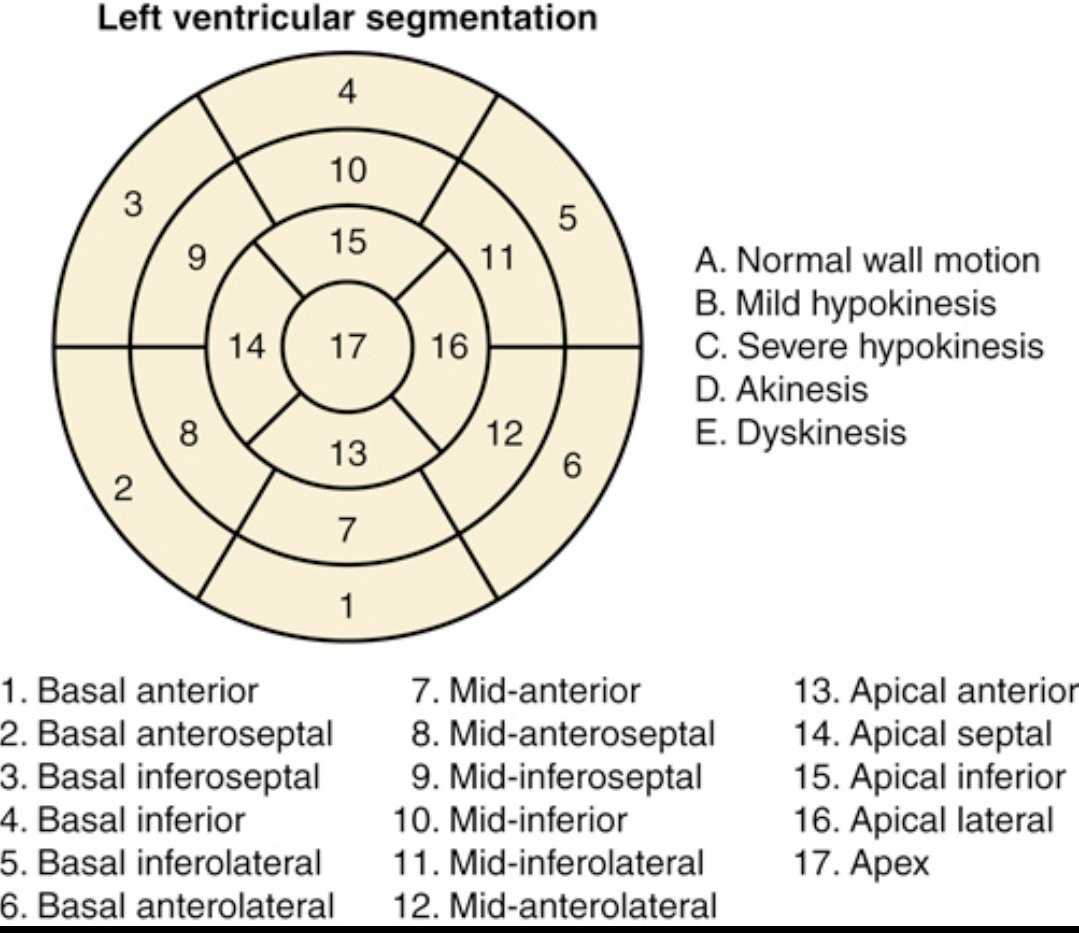 Understanding regional wall motion abnormalities (RWMA) starts with this: the 17-segment LV model.

It divides the left ventricle into basal, mid, apical segments for precise localization of dysfunction.

Why does it matter?
RWMA refers to areas of the LV wall that contract