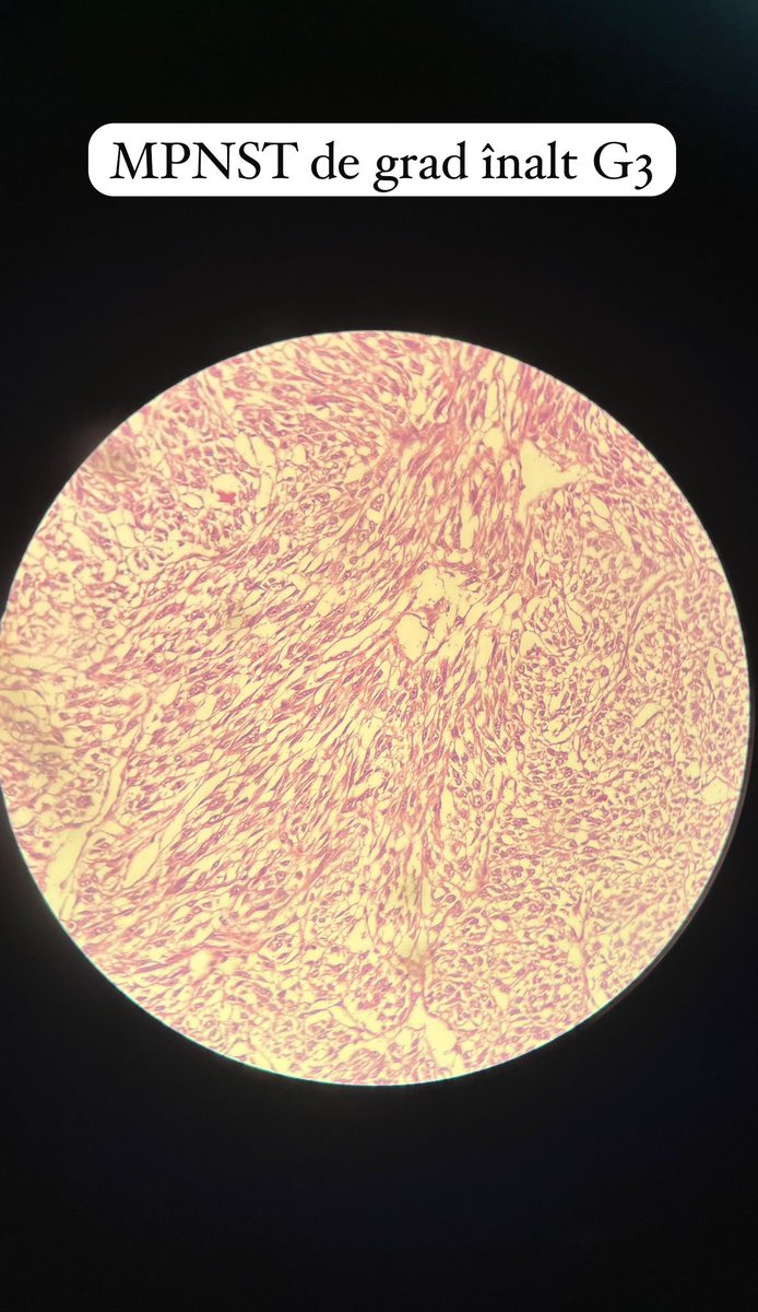 path_insights98's tweet photo. Dr. Angelo Paolo Dei Tos ending the #BSTPathology course 2025 in Barcelona, Spain with the lecture “How to avoid diagnostic errors in soft tissue pathology: a survival guide”. 📝
Last picture attached is a case from my personal archive related to the topic discussed. 🔬
#PathTwitter #BSTPath
#HMAR_BASTPC25 #PathX