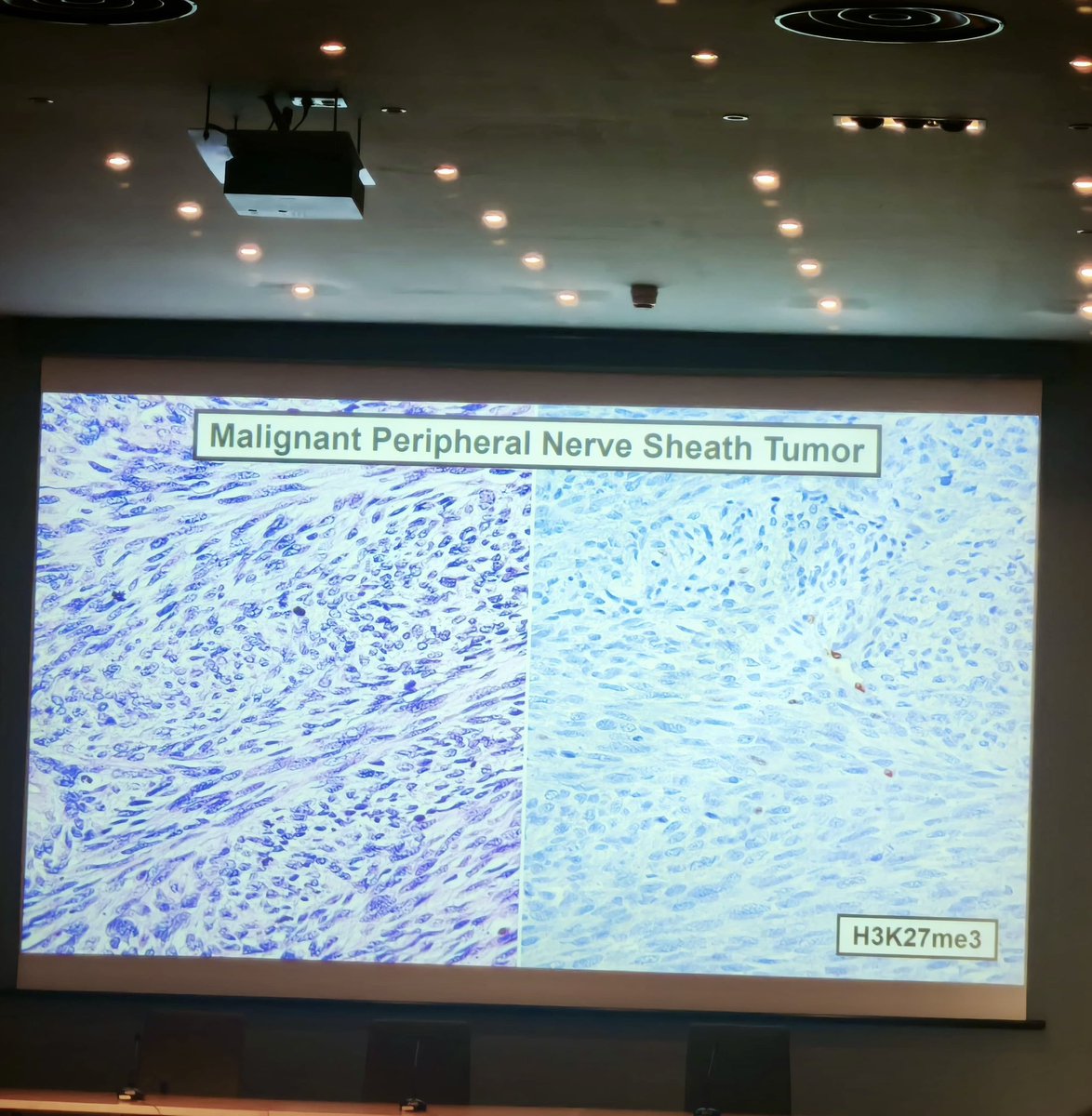 path_insights98's tweet photo. Dr. Angelo Paolo Dei Tos ending the #BSTPathology course 2025 in Barcelona, Spain with the lecture “How to avoid diagnostic errors in soft tissue pathology: a survival guide”. 📝
Last picture attached is a case from my personal archive related to the topic discussed. 🔬
#PathTwitter #BSTPath
#HMAR_BASTPC25 #PathX