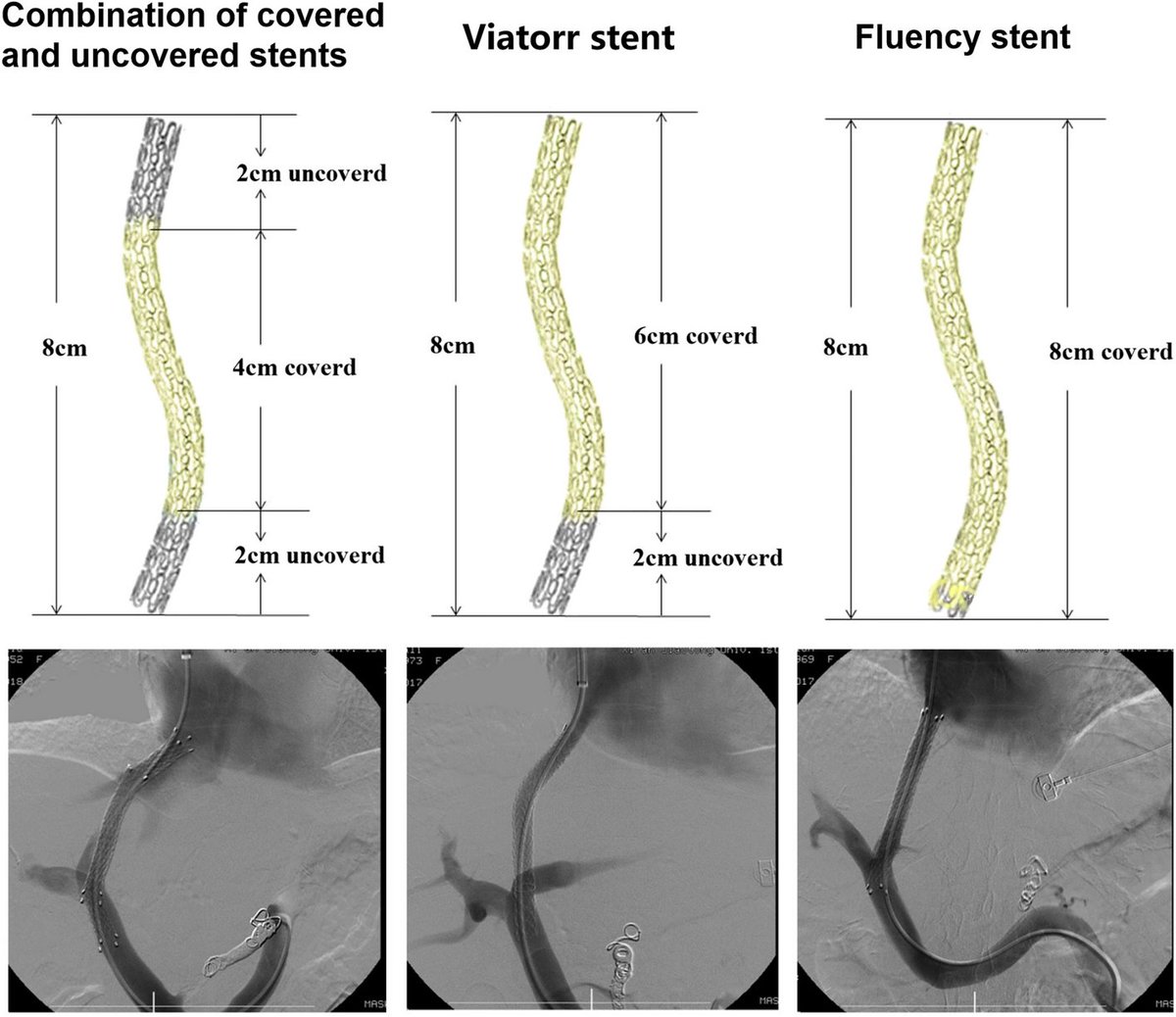 This paper explores the comparison of outcomes for transjugular intrahepatic portosystemic shunt creation: Viatorr versus Fluency versus a bare stent/Fluency stent combination

cvirendovasc.springeropen.com/articles/10.11…

#irad #interventionalradiology