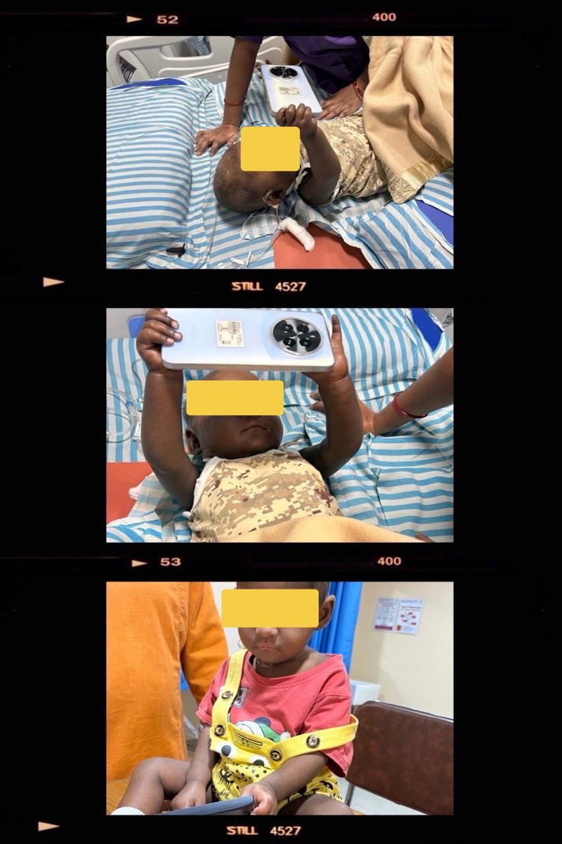 This 10 month old infant with refractory familial HLH enjoyed his Haplo #BMT treatment. Now post successful BMT 150 days enjoying all gadgets accessible. #BMTmagic
#PediatricHematology 
#pediatricOncology
⁦<a href="/basavatarakam/">Basavatarakam Indo American Cancer Hospital</a>⁩