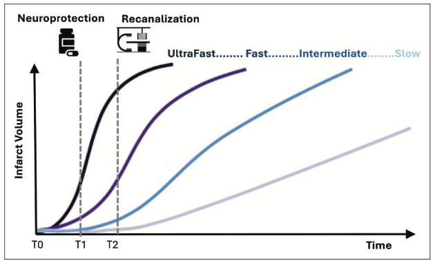 UPensato's tweet photo. Neuroprotection is most effective in a specific population (fast/ultrafast progressors) and at a specific time (early window). Check out our reasonings around infarct growth in #stroke published on @_JCBFM. @johanna_ospel 
https://t.co/kpPGlsTcFO https://t.co/0XOxO9GgJu