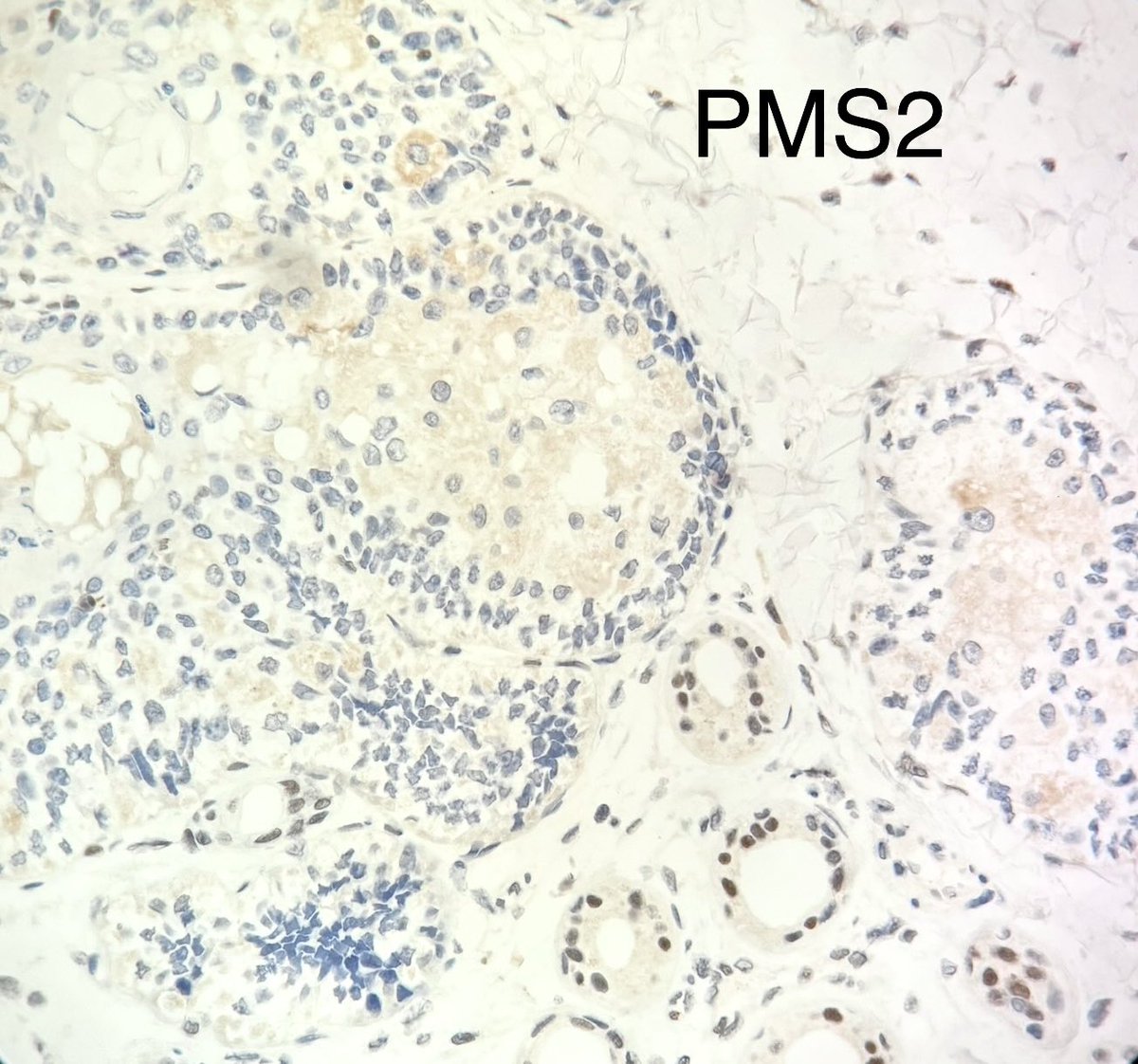 Squamous metaplasia in sebaceous neoplasms can be a clue for microsatellite instability (consider  possible Muir-Torre syndrome) #dermpath #pathology #dermatology #dermatopathology #MedX #PathX