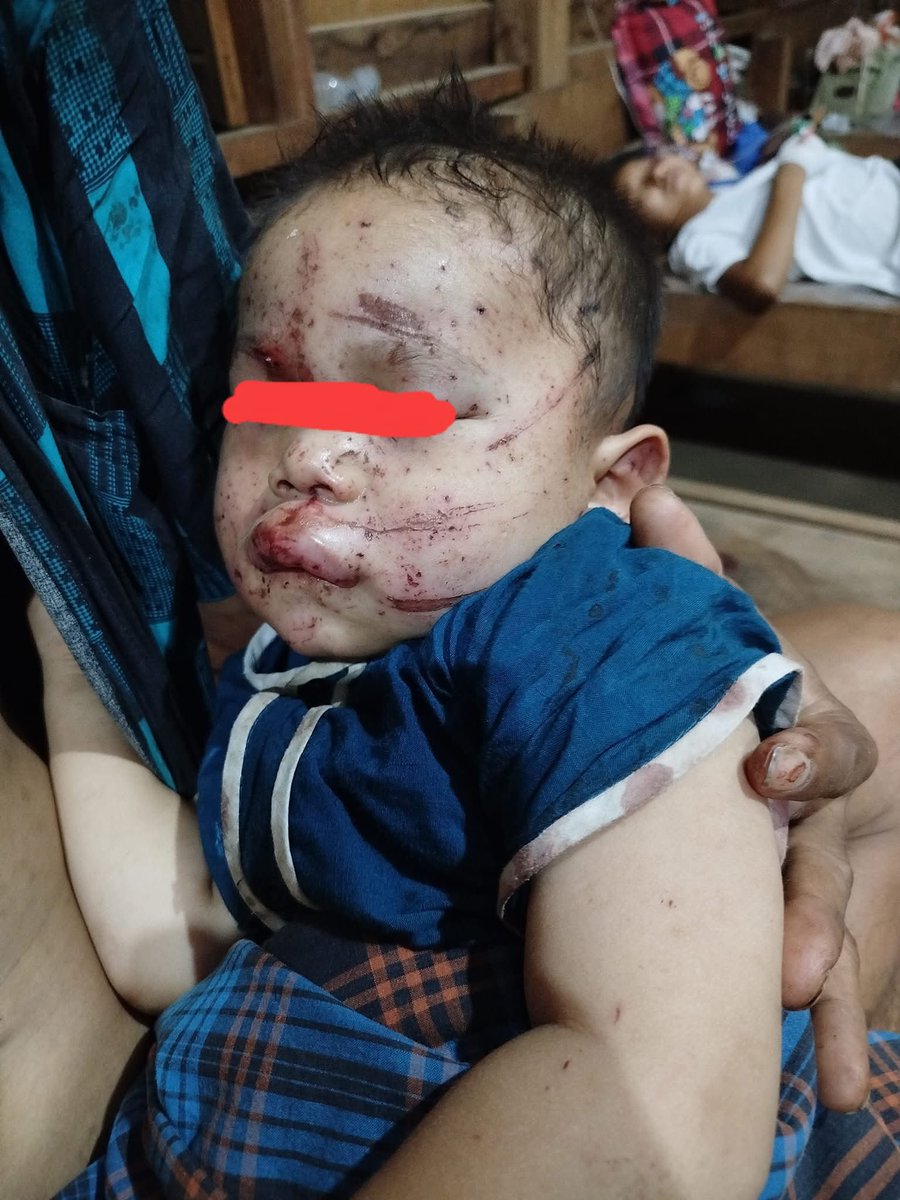 The kid who has lost parents and injured from Bomb blasting in Myanmar by Military Junta 😔