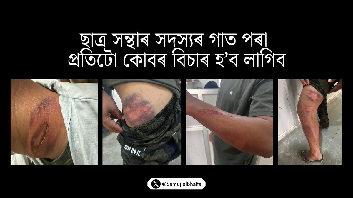 SamujjalBhatta's tweet photo. অসম আৰক্ষীয়ে বাহিৰ জোনাই আঞ্চলিক ছাত্ৰ সন্থাৰ উপদেষ্টা চন্দ্ৰকান্ত বৰুৱাক যোৱা নিশা অতি বৰ্বৰতাৰে অত‍্যাচাৰ চলাই গুৰুতৰ ভাৱে আহত কৰিলে।এই ঘটনাক ধিক্কাৰ দিছোঁ,তীব্ৰ গৰিহণা জনাইছোঁ।ছাত্ৰ সন্থাৰ সদস‍্যৰ গাত পৰা প্ৰতিটো কোবৰ বিচাৰ হ’ব লাগিব।

গৃহ বিভাগৰ দায়িত্বত থকা মুখ‍্যমন্ত্ৰীয়ে দোষী আৰক্ষীক দৃষ্টান্তমুলক শাস্তি প্ৰদান কৰক।এই ঘটনাৰ তদন্ত ঘোষণা কৰা হৈছে।আইনৰ সুৰুঙাৰে কোনো দোষী আৰক্ষী যাতে সাৰি যাব নোৱাৰে,তাৰ নিশ্চিত ব‍্যৱস্থা গ্ৰহণ কৰক।

@himantabiswa 
@CMOfficeAssam 
@DGPAssamPolice 
@assampolice