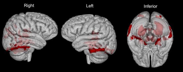 What can a rare neurometabolic disorder teach us about schizophrenia?

Niemann-Pick Type C (NPC) is a lysosomal disorder that disrupts cholesterol trafficking.

In adults, it often presents as a psychotic illness — long before neurological signs emerge.

Here’s what NPC reveals
