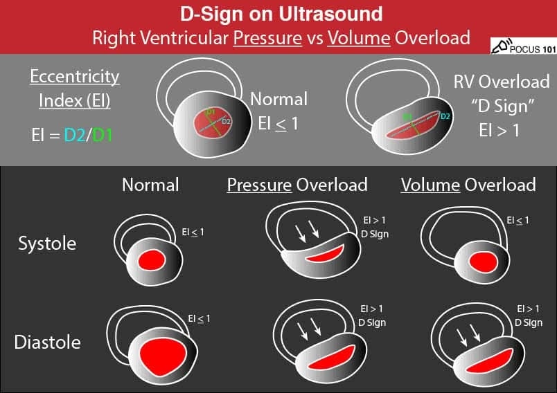 ZHeart11768530's tweet photo. 🔴 The D Sign – Right Heart Strain from Pressure vs Volume Overload

💔Differentiating between RV pressure and volume overloads 👌🏼 https://t.co/IiYMTkFP11
 #medtwitterWhat #MedTwitter #CardioEd #medx #medEd #CardioTwitter #cardiotwitter #MedX #MedEd #cardiology #cardiotwiteros https://t.co/AX3tpabyIW