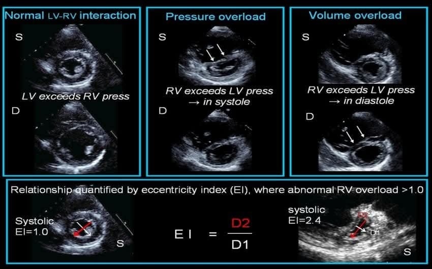ZHeart11768530's tweet photo. 🔴 The D Sign – Right Heart Strain from Pressure vs Volume Overload

💔Differentiating between RV pressure and volume overloads 👌🏼 https://t.co/IiYMTkFP11
 #medtwitterWhat #MedTwitter #CardioEd #medx #medEd #CardioTwitter #cardiotwitter #MedX #MedEd #cardiology #cardiotwiteros https://t.co/AX3tpabyIW