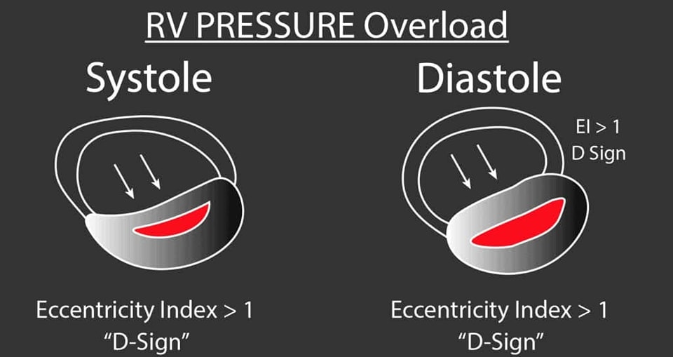 ZHeart11768530's tweet photo. 🔴 The D Sign – Right Heart Strain from Pressure vs Volume Overload

💔Differentiating between RV pressure and volume overloads 👌🏼 https://t.co/IiYMTkFP11
 #medtwitterWhat #MedTwitter #CardioEd #medx #medEd #CardioTwitter #cardiotwitter #MedX #MedEd #cardiology #cardiotwiteros https://t.co/AX3tpabyIW