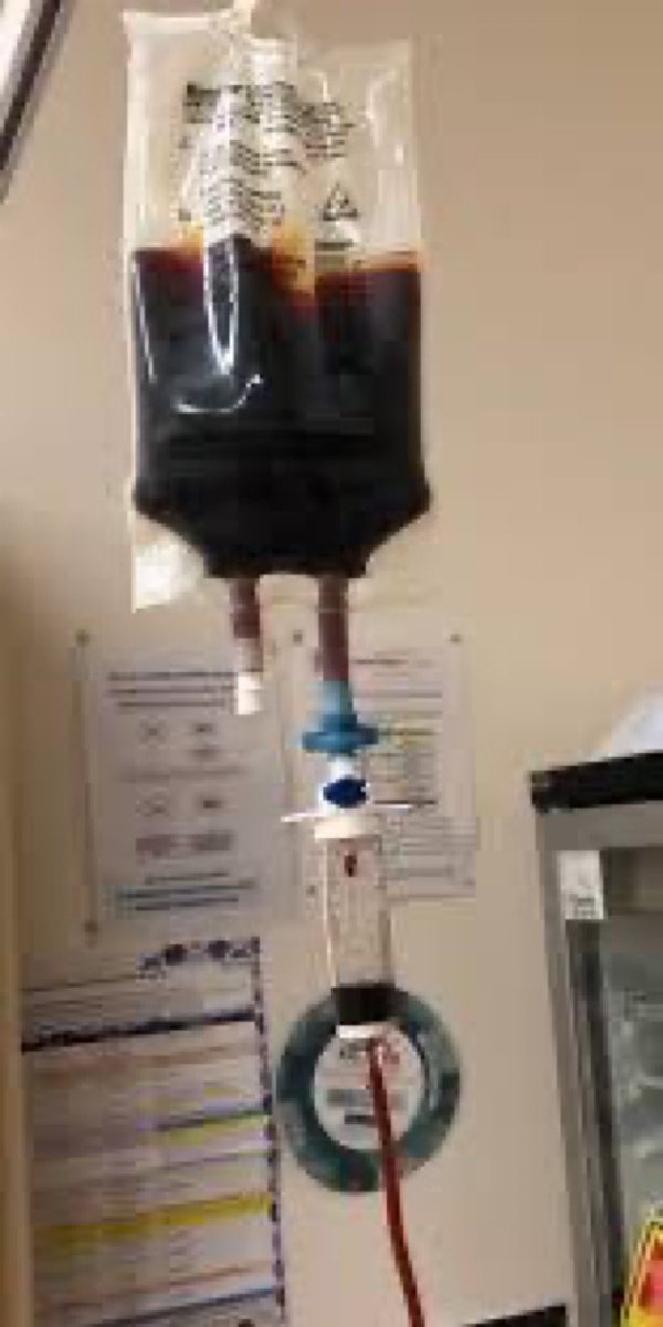 معلومات عن 
أخذ الحديد بالوريد في الحمل :

✅علاج آمن للأم والجنين
 
 ✅فعّال في علاج الانيميا

✅ينصح به بعد ١٢ اسبوع لمن لم تتحمل حبوب الحديد
 
✅ ينصح به بعد ٣٢ اسبوع لمن حاولت اخذ حديد بالفم ولم يرتفع 

#ثقافتك_تحميك