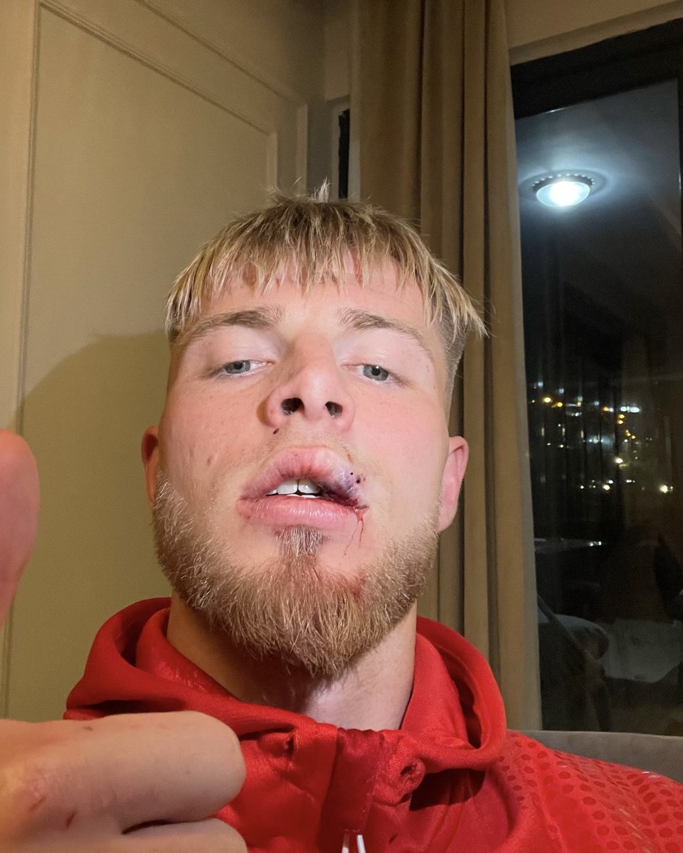 Oyuncumuz Rick van Drongelen’in, sarı kart gördüğü pozisyonda ağzına almış olduğu darbe sonucu dudağı yarılmış ve sahada yapılan müdahalenin ardından maça devam edebilmiştir.

Müsabaka sonrasında, sağlık sponsorumuz VM Medicalpark Samsun Hastanesi’nde yapılan kontrollerde,