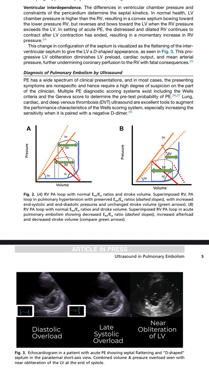 Mohammed Megri. MD (@megrimohammed) on Twitter photo Check out this insightful paper by <a href="/siddharth_dugar/">Siddharth Dugar MD FCCM,FCCM,FASE</a> on the pathophysiology of pulmonary embolism and POCUS! Enjoy reading!
lnkd.in/gjNzWGBW
lnkd.in/g9d2F2zy Check out this insightful paper by <a href="/siddharth_dugar/">Siddharth Dugar MD FCCM,FCCM,FASE</a> on the pathophysiology of pulmonary embolism and POCUS! Enjoy reading!
lnkd.in/gjNzWGBW
lnkd.in/g9d2F2zy