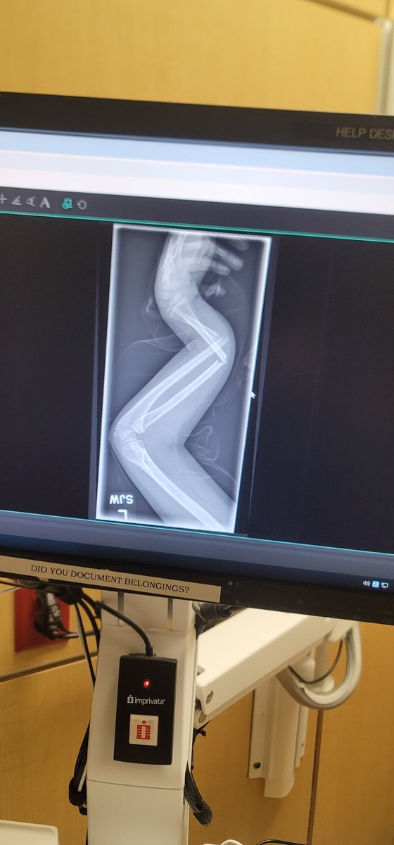 My daughter broke her arm last night. She got a running start dove head first over her cushions fort to try to land on her hand for "the greatest hand stand ever."