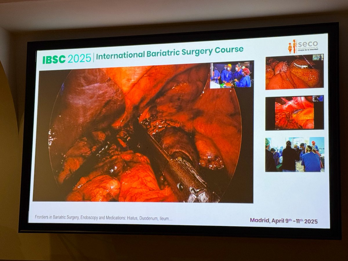 MontseAdellT's tweet photo. Great days in Madrid at the #IBSC2025! Amazing and innovative talks together with live surgeries by the top experts in the field. 
Happy to participate talking about “The point of view of early adopters” in robotic bariatric and metabolic surgery
@obesidadSECO https://t.co/ZXTCR5IqOp