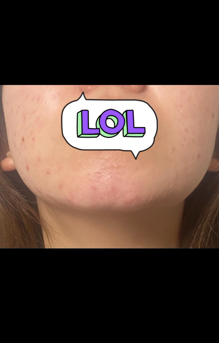 1👉🏻去年7月後半
2.3👉🏻去年の9月中旬
4👉🏻今

しんどすぎて､何かしらの理由つけて大学休んだり､遅く行ったり､友達との予定ドタキャン(最低)したりもしたなー。
だいぶできにくはなったけどまた夏に荒れるのかな､､今年は絶対阻止！！
とりあえず跡が酷いし手強い