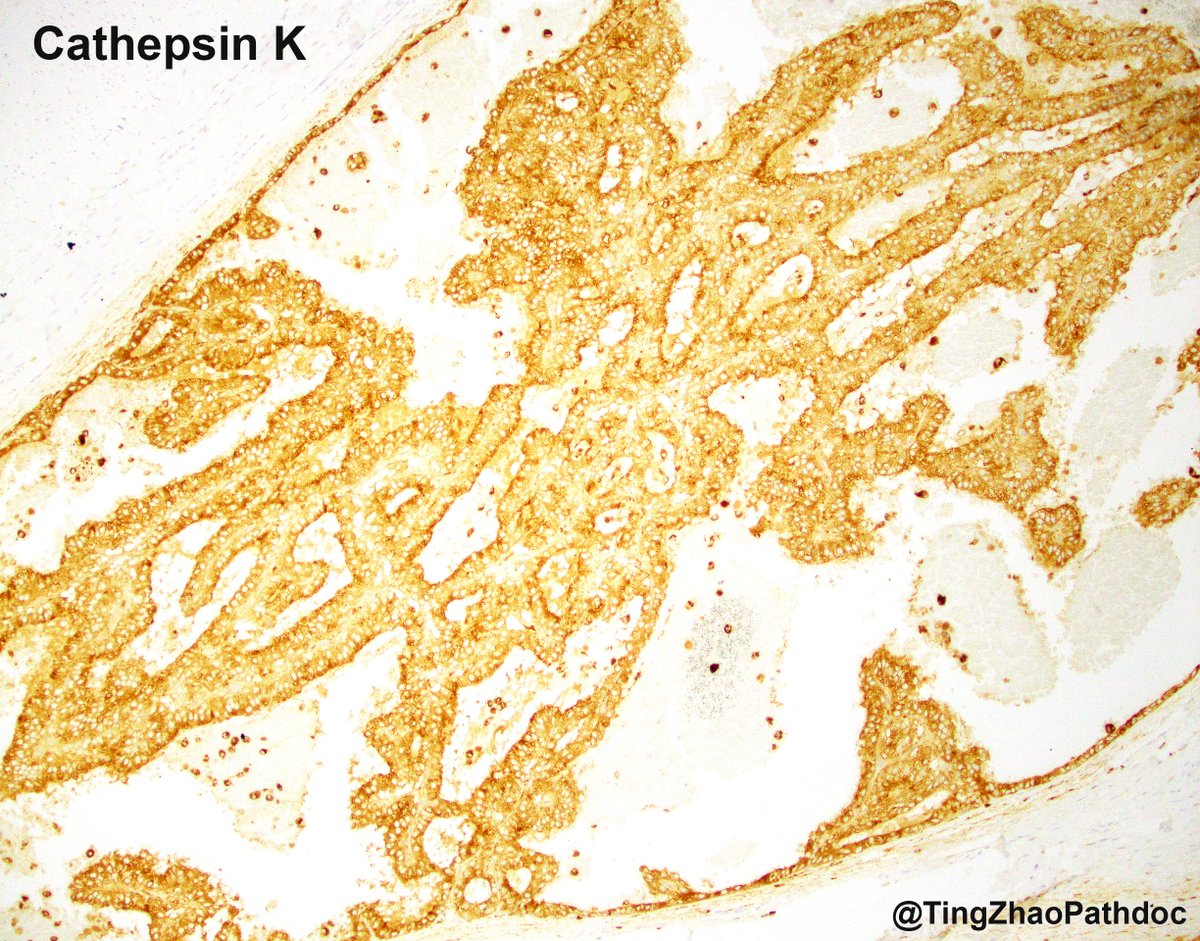 <a href="/MGBpathology/">Mass General Brigham Pathology</a> <a href="/MGHPathology/">MGH Pathology</a> TFE3-rearranged RCC (PRCC::TFE3 fusion identified)
- Papillary architecture, clear to eosinophilic cytoplasm
- Psammoma bodies may be present
- Other architectures: nested, solid, tubular, cystic, alveolar
- The 3 most common fusion partners: PRCC, ASPSCR1, SFPQ
#GUpath  #Molpath