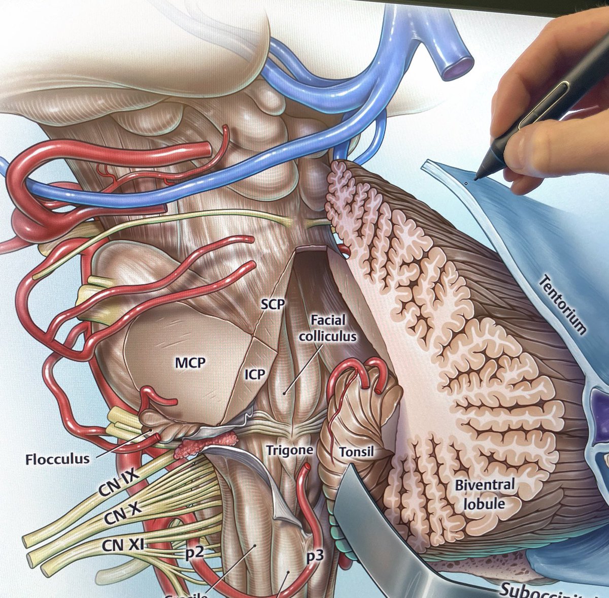 Peter M. Lawrence (@petermlawrence1) on Twitter photo Posterolateral brainstem. What anatomy do you see? <a href="/OGdukeneurosurg/">Oren Gottfried, MD</a> <a href="/Cuneatos/">Neuroanato 2.0</a> 🧠✍️ Posterolateral brainstem. What anatomy do you see? <a href="/OGdukeneurosurg/">Oren Gottfried, MD</a> <a href="/Cuneatos/">Neuroanato 2.0</a> 🧠✍️