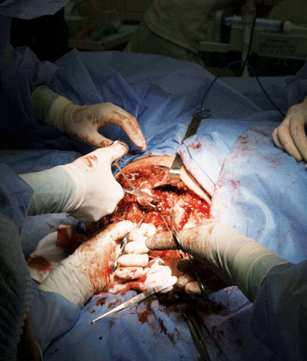 6 діб з турнікетом.

6 діб, коли людина чекала на можливість евакуації, бо російські щільні обстріли не давали можливості проїхати.

Але згуртована робота команди на місці + якісна робота медиків на всіх рівнях.

І людина буде жити попри бажання ворога не дати цьому статися.