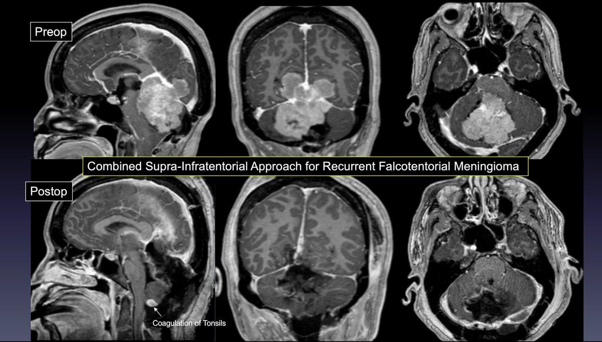 SkullBaseMD's tweet image. Preview of tomorrow's webcast on "Journey to the Center of the Brain: The Roads Less Traveled":
Case of a patient who was becoming quadriparetic and losing ability to walk due to a large recurrent falcotentorial meningioma compressing the brainstem and pushing the tonsils…