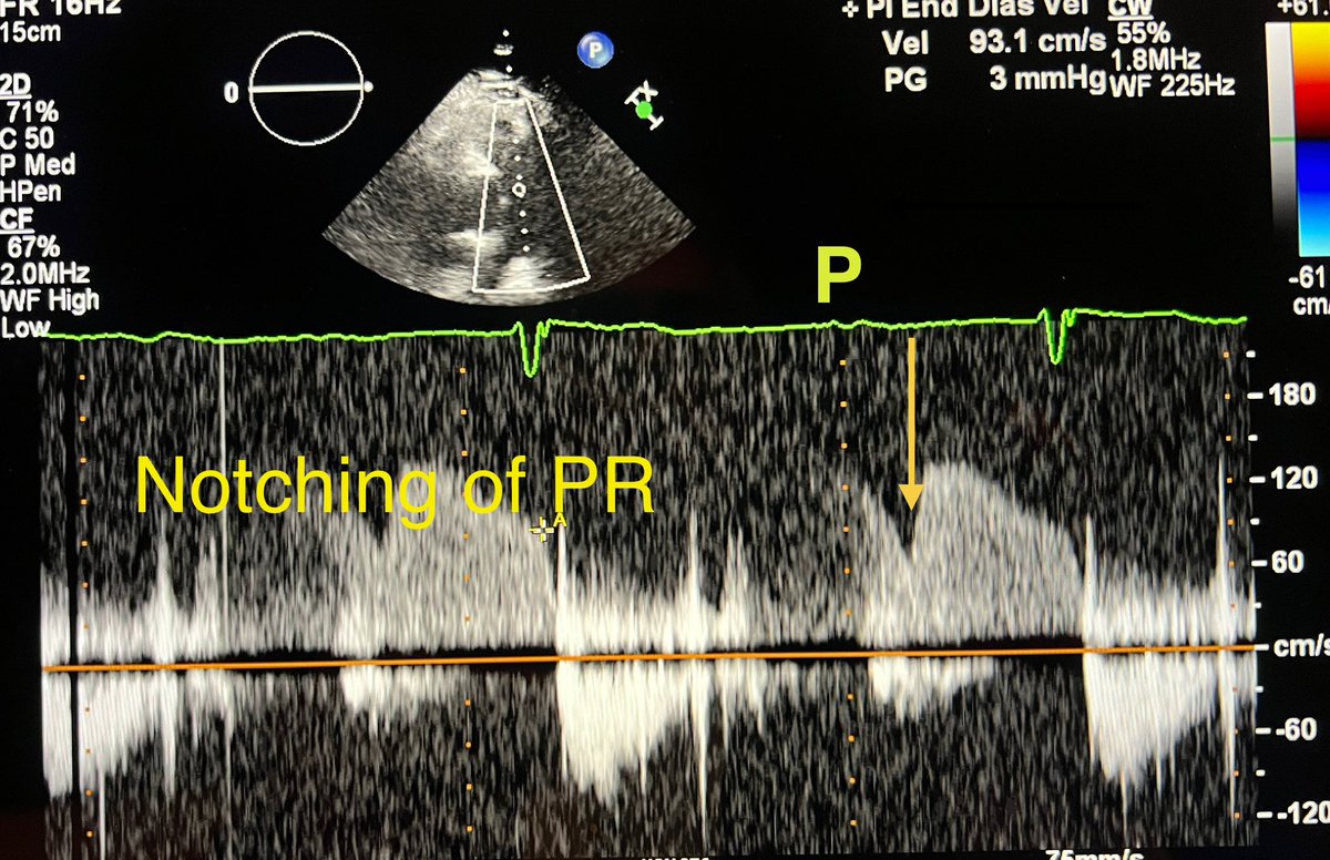 Time to close out #echofirst 
✅ Diagnosis: (Very) Long PR and premature MV (&amp; TV) closure ⬇️
✅ Diastolic MR &amp; TR (sequel to premature TV and TV closure)- almost expected  
✅ Interesting and rare mid-diastolic notching of PR Doppler ⬇️ due to long AV delay (PR itself is