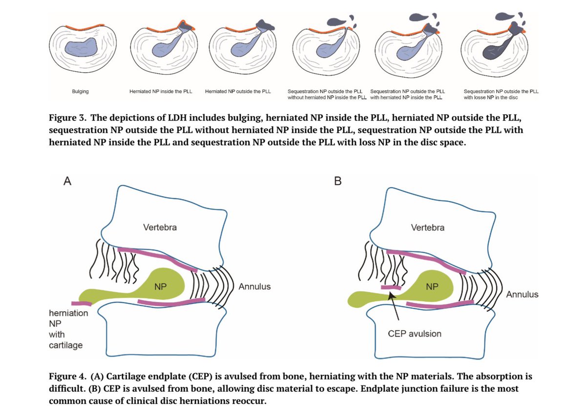 Prevalence, clinical predictors, &amp; mechanisms of resorption in lumbar disc herniation: a systematic review
pmc.ncbi.nlm.nih.gov/articles/PMC11…
76.6% in LDH patients undergo NP resorption. Prolapsed NP has a greater contact surface with blood system, which is easily to trigger immune response