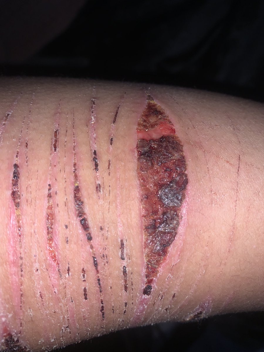 Vampiree_bite's tweet photo. kms they are very itchy https://t.co/LTQ0qb5l0o