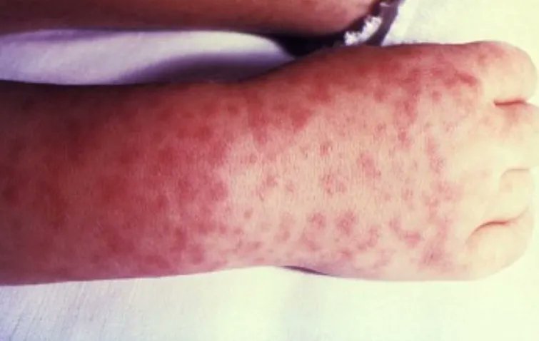bactiman63's tweet photo. #Mexico: Seven states reporting #spottedfever in 2025 to date https://t.co/RaY33maJNL https://t.co/OsfT4ioLvU