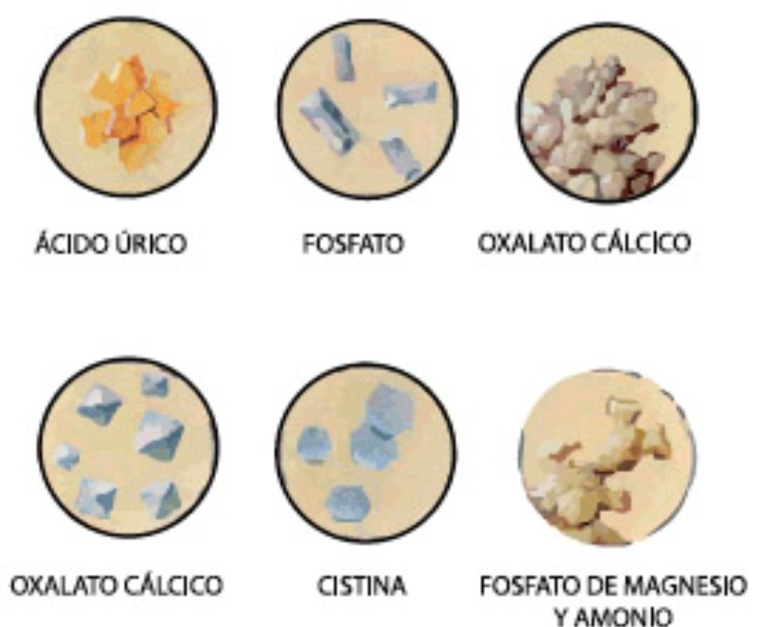 nakamartinez's tweet image. #Pregunto Qué remedio casero recomiendan para expulsar un cálculo renal mínimo (4mm) ? Mil gracias 🫂