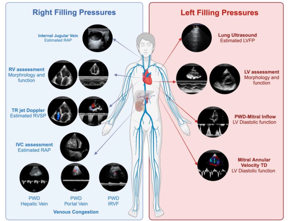Gregorio Romero-González (@tubulocentric) on Twitter photo Grateful to our co-authors and mentors. <a href="/KoraAbhi/">Abhilash Koratala</a> <a href="/AmirKazory/">Amir Kazory</a> <a href="/MartaCoboMarcos/">Marta Cobo Marcos</a> <a href="/croncoIRRIV/">Claudio Ronco</a> <a href="/CardioRenalSEC/">Síndrome CardioRenal y Congestión en IC</a>
We move forward toward a more precise, ultrasound-driven, patient-centered nephrology. <a href="/JonathanNefro/">Jonathan Chávez</a> <a href="/SENefrologia/">S.E.N. Nefrología</a> <a href="/DraMarili/">Lilia Rizo</a> <a href="/ERAkidney/">ERA - European Renal Association</a> <a href="/escardio/">European Society of Cardiology</a> <a href="/VDelgadoGarcia/">Victoria Delgado</a> Grateful to our co-authors and mentors. <a href="/KoraAbhi/">Abhilash Koratala</a> <a href="/AmirKazory/">Amir Kazory</a> <a href="/MartaCoboMarcos/">Marta Cobo Marcos</a> <a href="/croncoIRRIV/">Claudio Ronco</a> <a href="/CardioRenalSEC/">Síndrome CardioRenal y Congestión en IC</a>
We move forward toward a more precise, ultrasound-driven, patient-centered nephrology. <a href="/JonathanNefro/">Jonathan Chávez</a> <a href="/SENefrologia/">S.E.N. Nefrología</a> <a href="/DraMarili/">Lilia Rizo</a> <a href="/ERAkidney/">ERA - European Renal Association</a> <a href="/escardio/">European Society of Cardiology</a> <a href="/VDelgadoGarcia/">Victoria Delgado</a>