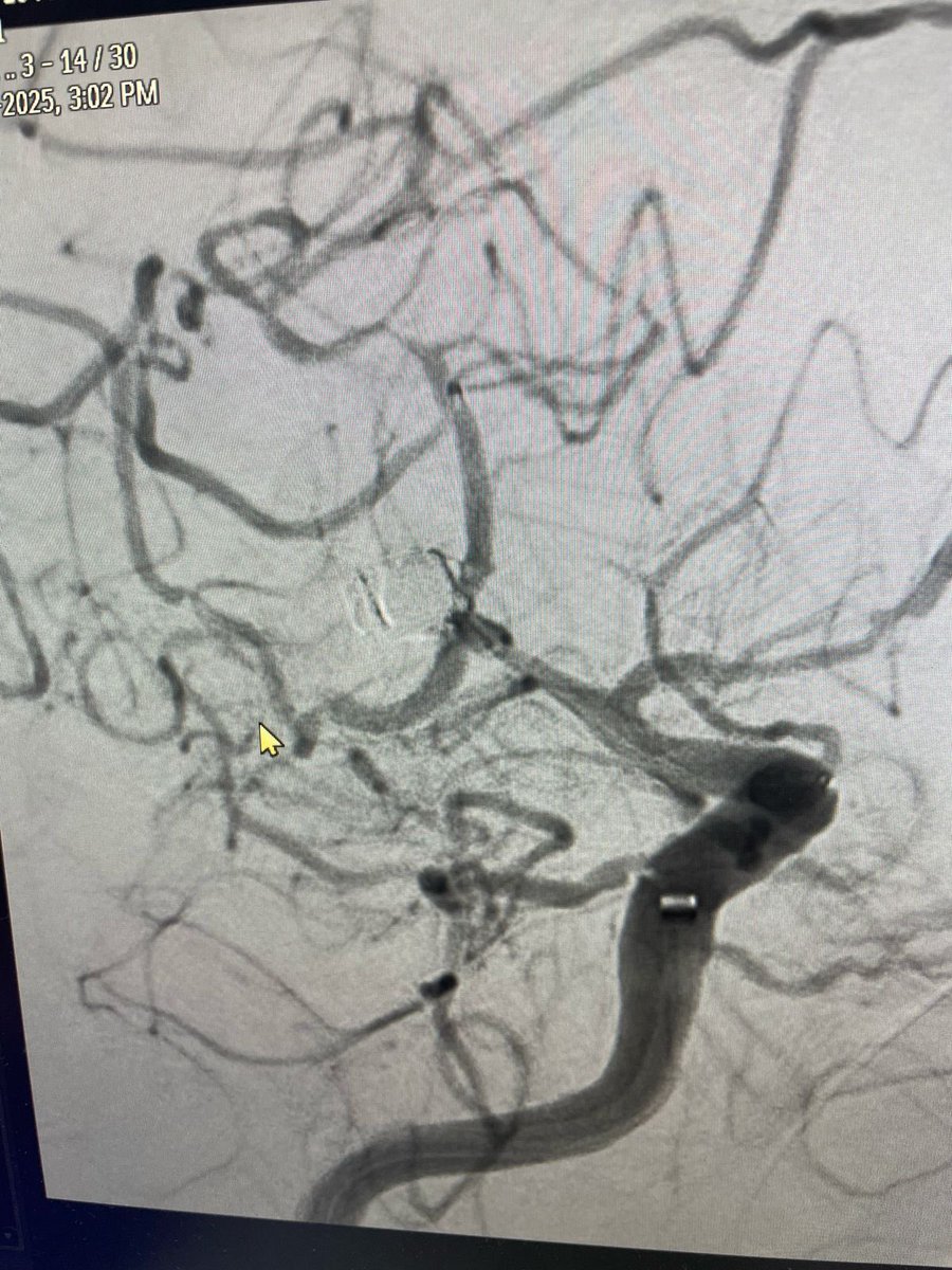Abdulrahman Hamad Al-Abdulwahhab (@da7om206) on Twitter photo Y stent approch for unruptured MCA bifurcation aneurysm Y stent approch for unruptured MCA bifurcation aneurysm