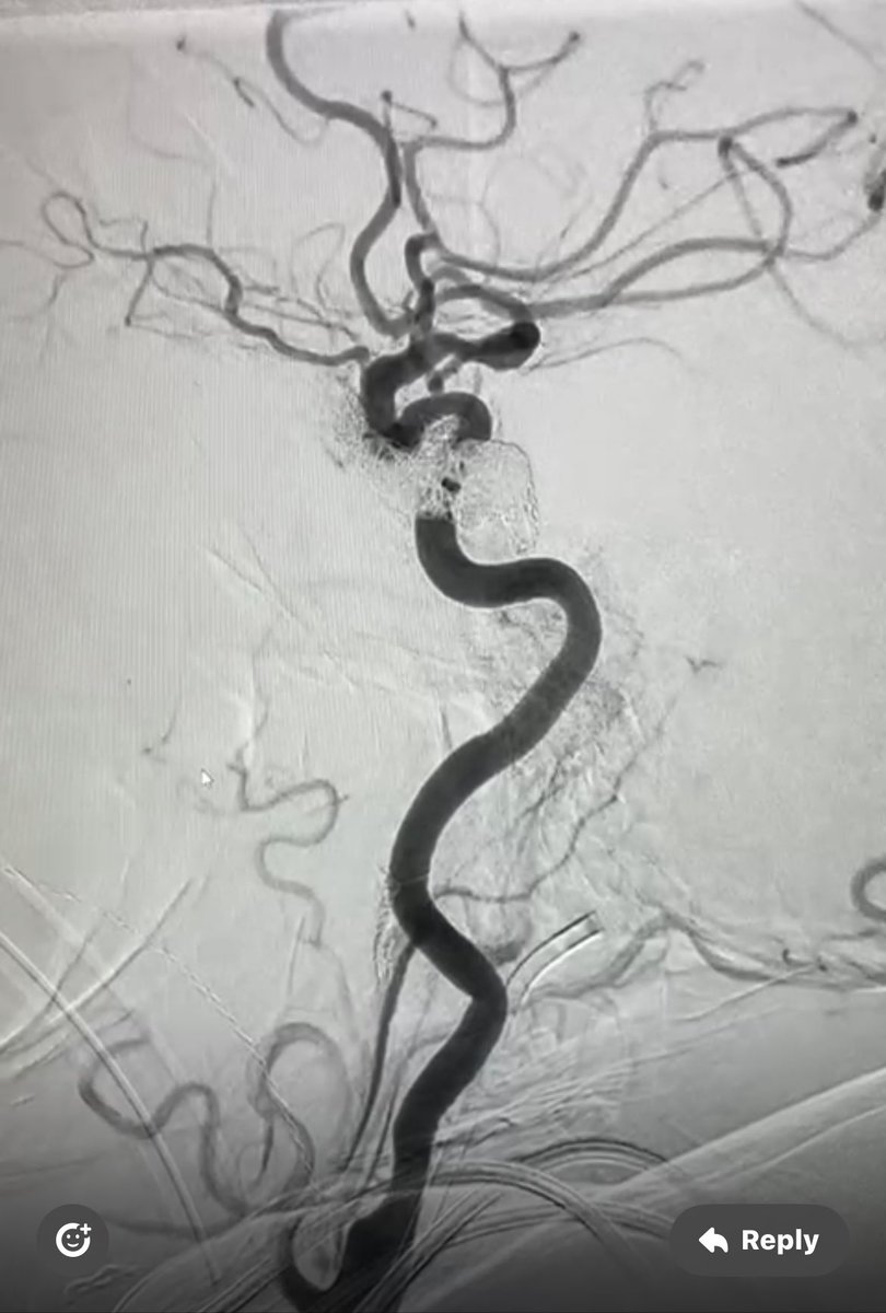 Abdulrahman Hamad Al-Abdulwahhab (@da7om206) on Twitter photo Indirect CCF embolization through facial vien approach Indirect CCF embolization through facial vien approach