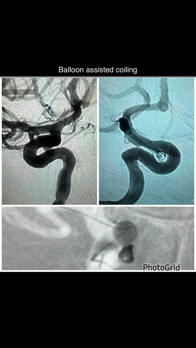 AlAli Meshari , MD د.مشاري العلي (@mesharyalali) on Twitter photo Case of SAH (ruptured aneurysm)
Using balloon for detouring (sellection)
And for assisting coiling
Balloon does the job
👍 Case of SAH (ruptured aneurysm)
Using balloon for detouring (sellection)
And for assisting coiling
Balloon does the job
👍