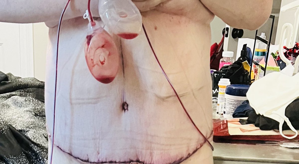 PatsKam's tweet photo. I wish I never let my body get fat. I hate that I had to spend thousands of dollars to fix the damage I had done after finally losing the weight, but I am also damn proud of who I am because of it all. 

Before weight loss, after loss, after skin removal, and healed (today) ❤️ https://t.co/u0RUdRN3tm