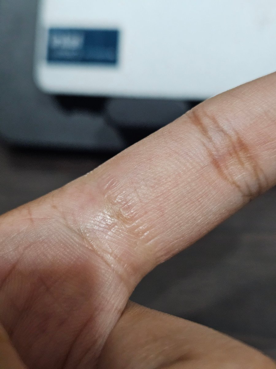 unboxmatrix's tweet image. #techgeeks

Need inputs from primarily all Galaxy Ring users but any other smartrings user review would be great too.

1. Do you wear ring in one finger only ?
2. If yes, have you faced any such issues ? (In  1 month of usage)

--
@imYadav31 @AnshuTechblog @YourbroRishabh…