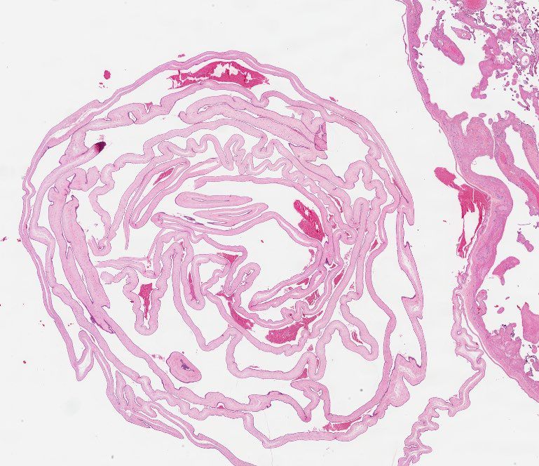 Path4People's tweet image. Twins 👯‍♀️ are born!

Dividing membrane ⬇️ 

What kind of twins are they?
Diamniotic-Dichorionic (Di-Di)
Diamniotic-Monochorionic (Di-Mo)
Monoamniotic-Monochorionic (Mo-Mo)

📸 Credit: Kelly Hall, MD
#pathx #pedipath #obgyn
