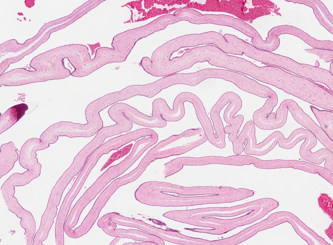 Path4People's tweet image. Twins 👯‍♀️ are born!

Dividing membrane ⬇️ 

What kind of twins are they?
Diamniotic-Dichorionic (Di-Di)
Diamniotic-Monochorionic (Di-Mo)
Monoamniotic-Monochorionic (Mo-Mo)

📸 Credit: Kelly Hall, MD
#pathx #pedipath #obgyn