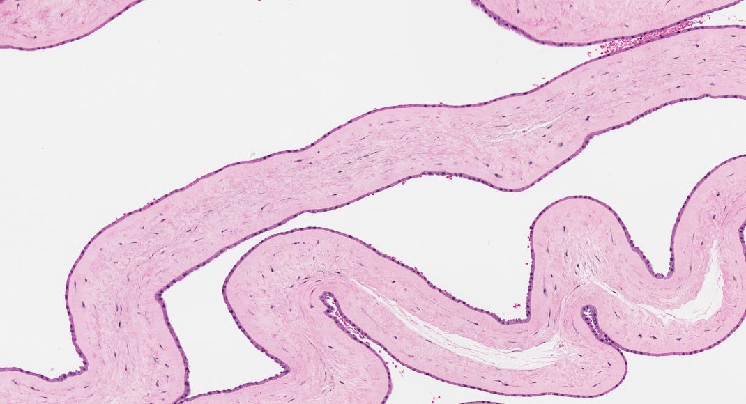 Path4People's tweet image. Twins 👯‍♀️ are born!

Dividing membrane ⬇️ 

What kind of twins are they?
Diamniotic-Dichorionic (Di-Di)
Diamniotic-Monochorionic (Di-Mo)
Monoamniotic-Monochorionic (Mo-Mo)

📸 Credit: Kelly Hall, MD
#pathx #pedipath #obgyn