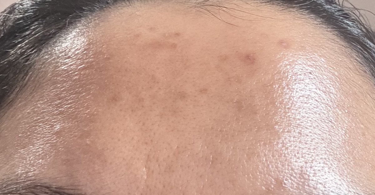 archiveofblues's tweet photo. @konstelaasi @celeverythings Ini foto before afternya yaa menurut aku sih udah mendingan banget sejak ganti sama set skincare ini, tinggal bekas hitam jerawatnya ajaa
Before                                                                     After https://t.co/nt0FbH14o3