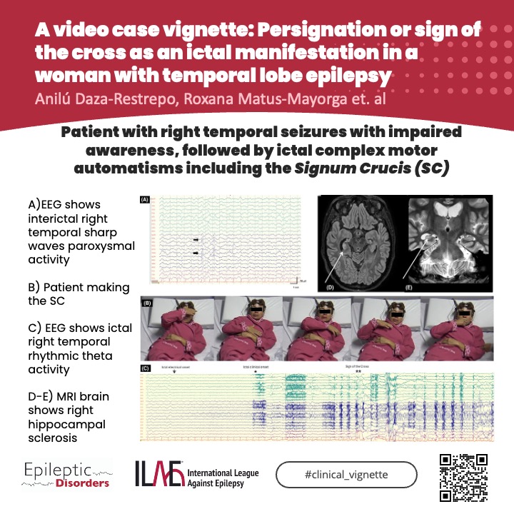 Epileptic Disorders (@epidisorders) on Twitter photo 💡Signum Crucis is an ictal complex motor automatism in patients with temporal lobe #epilepsy - possibly a learned behavioral automatism.
Check case for more info!
🔗 doi.org/10.1002/epd2.2…
<a href="/giocastellucci/">Giovanni Castellucci, MD, MS</a> <a href="/SheikhISMD/">irfan sheikh 伊凡</a> <a href="/joanajribeiro/">Joana Ribeiro</a> <a href="/SBeniczky/">Sandor Beniczky</a> <a href="/AnphyLab/">The AnPhy Lab</a> <a href="/yesILAE/">yesILAE</a> <a href="/krishnap15/">Radhakrishna</a> 💡Signum Crucis is an ictal complex motor automatism in patients with temporal lobe #epilepsy - possibly a learned behavioral automatism.
Check case for more info!
🔗 doi.org/10.1002/epd2.2…
<a href="/giocastellucci/">Giovanni Castellucci, MD, MS</a> <a href="/SheikhISMD/">irfan sheikh 伊凡</a> <a href="/joanajribeiro/">Joana Ribeiro</a> <a href="/SBeniczky/">Sandor Beniczky</a> <a href="/AnphyLab/">The AnPhy Lab</a> <a href="/yesILAE/">yesILAE</a> <a href="/krishnap15/">Radhakrishna</a>