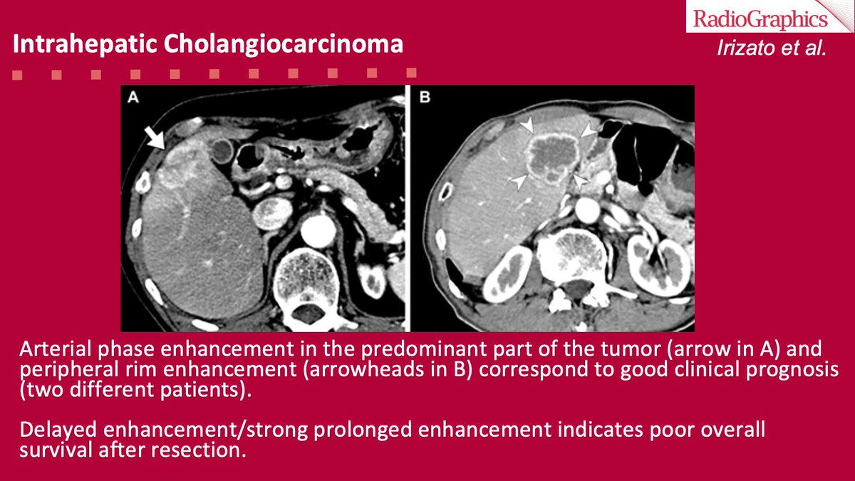 sbastawrous1's tweet photo. Arterial hyperenhancement can help select therapeutic agents because the association with peripheral intrahepatic cholangiocarcinomas and genetic mutations. Volumetric ADC and hyperenhancement may be an indicator for conversion surgery in unresectable ICCs
#RGphx #GIRad https://t.co/KgmhbQMnB9