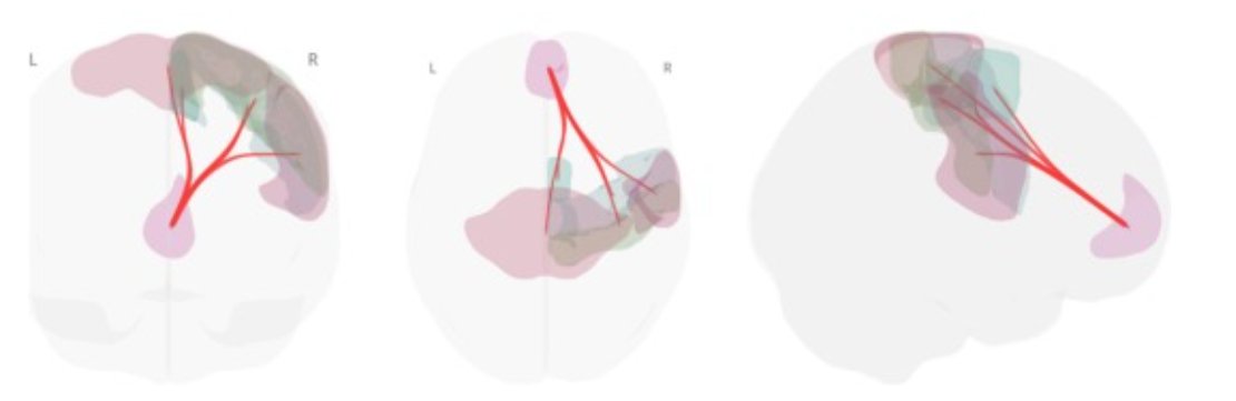 eic_nic's tweet image. Short-term BCI intervention enhances functional brain connectivity associated with motor performance in chronic stroke
BCI training enhances connectivity between the DMN and motor-related regions
sciencedirect.com/science/articl…