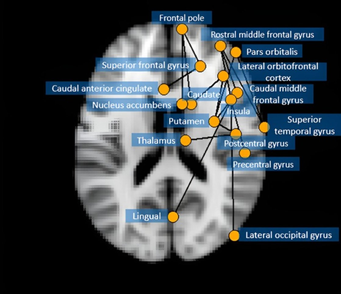 eic_nic's tweet image. Structural brain networks related to language in preterm children
sciencedirect.com/science/articl…
Extreme preterm born children might use compensatory neural pathways for language to make up for their neuronal dysmaturation