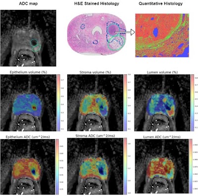 Radiology_AI's tweet photo. Physics-Informed Autoencoder provided accurate #prostate tissue biomarker measurements from #MRI data https://t.co/dBiyAo95KC @UChicagoRADS @NURadiology #autoencoder #ProstateCancer #MachineLearning https://t.co/rlazq4zRVb