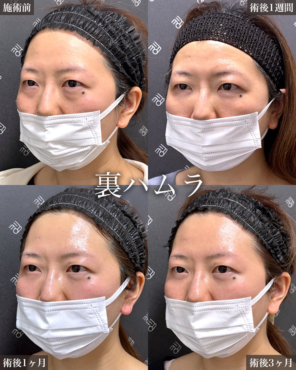 「裏ハムラ」の術後経過‼️

1週間時点で、マスクありなら腫れは目立たないです。

月単位でさらにスッキリしていきます。