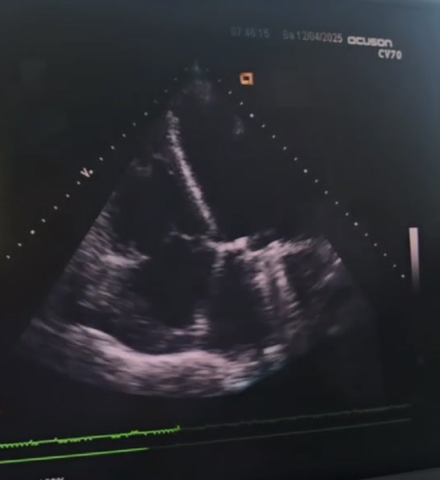 agwar_fekede's tweet photo. In a six hours long heart surgery local cardiac team of Ethiopia successfully performed the first Sub-Mitral aneurysm repair along with Mitral valve replacement for a 31 years old patient. https://t.co/7PkjMjTwnW